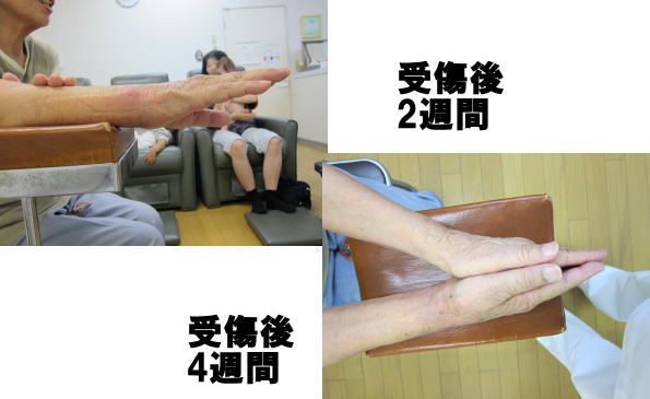 橈骨骨折2週間