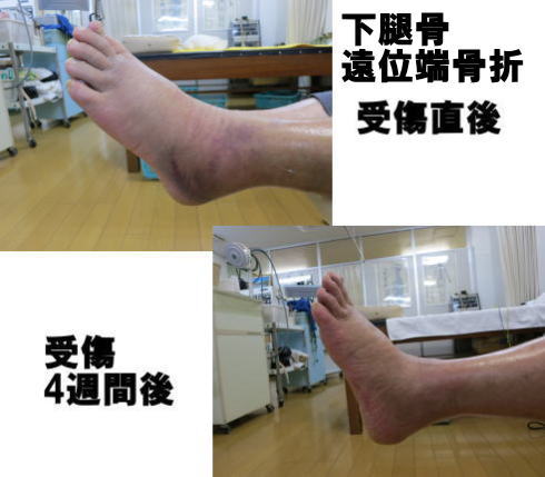 下腿骨骨折