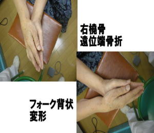 橈骨骨折