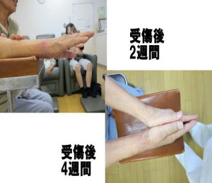 橈骨骨折2週間